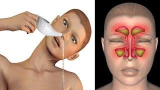 Clear Your Sinuses Natural Remedies for Sinus Pressure and Congestion