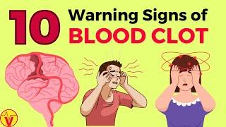 10 WARNING Signs of BLOOD CLOT  Blood Clot Signs   VisitJoy