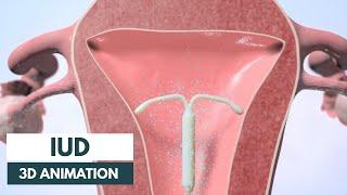 How does an IUD work?  3D animation