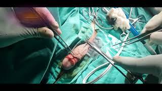 Dr Bimalesh Purkait Circumcision  Phimosis Surgery