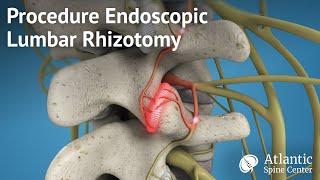 Procedure Endoscopic Lumbar Rhizotomy