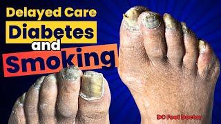 Delayed Care Diabetes and Smoking Treating Thick Fungal Toenails