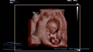 Scan of the Week 11 Week Early Pregnancy Scan