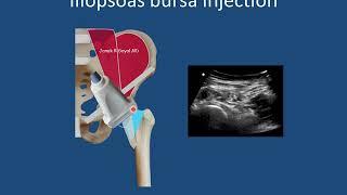 Ultradsound guided procedures hip