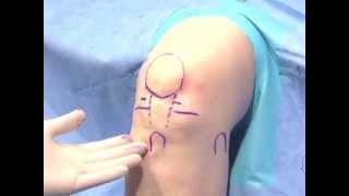 Arthroscopic Knee Surgery Video Part 2 Surface Anatomy & Placement  Albuquerque Orthopedic Surgeon