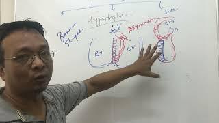 Cardiomyopathytypes and pathophysiology