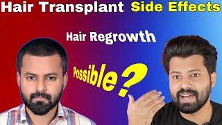 Hair Transplant PRP GFC Side Effects  Bald Hair Regrowth Possible ? Ask Doctor Part 1