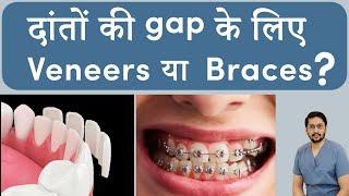 Indias Most Popular Teeth Gap Treatment Options 2024  Dental veneers in India Braces in Indore