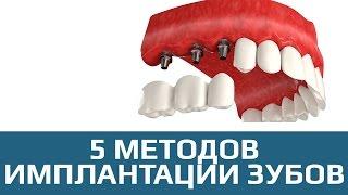 Имплантация зубов. 5 методов имплантации зубов