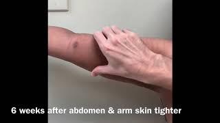 Renuvion J plasma Arms pinch test before& after Drew Varano MD Washington DC 202 621 8675