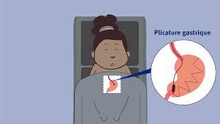 CIO - Traitements endoscopiques de lobésité