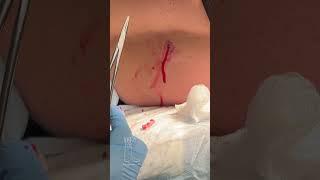 Sebaceous Cyst Small but necessary