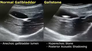 Gallstone Ultrasound Real-Time Scan Normal Vs Abnormal Appearance  Cholelithiasis  Gallbladder USG