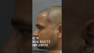 5 Months Hair Transplant Results Before After #hairtransplantinindia