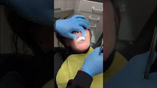  Тимчасова реставрація зубів #зуби #стоматологія #коронки