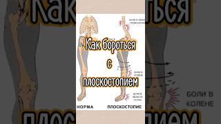 Как бороться с плоскостопием