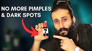 Simple Solution For Pimples Dark spots Pigmentation  Bearded Chokra