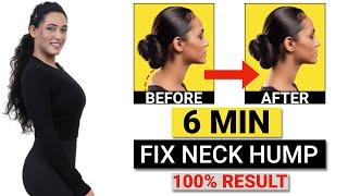 How to Fix a Neck Hump at Home FAST Fix Neck Hump FAST With These Home Exercises GymNought