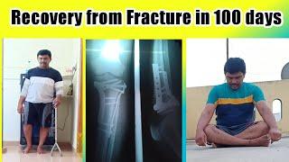 Recovery from fracture in 100 days  Tibial and fibular head fracture  Leg Fracture Recovery