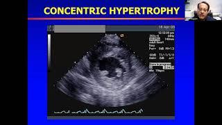 Guideline Webinar Recommendations for Multimodality Cardiovascular Imaging of Patients with HCM