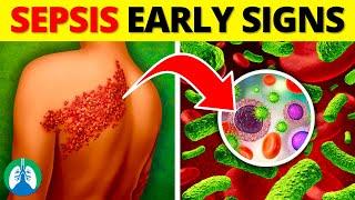 Top 10 Early Warning Signs of Sepsis  NEVER Ignore THIS