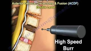 Cervical Spine Decompression And Fusion . - Everything You Need To Know - Dr. Nabil Ebraheim