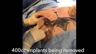 Implant Exchange How a Implant Exchange Is Done