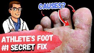 BEST 9 Athletes Foot Fungus Remedies & the #1 Big Mistake