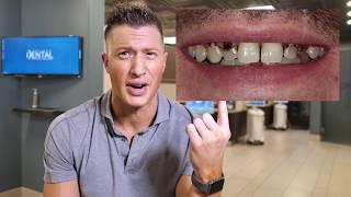 Dentist says DO NOT CROWN YOUR TEETH - Proves it with a Clinical example