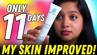  Improve Your Skin in Just 11 Days My Before & After Results with La Roche-Posay Effaclar Duo