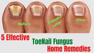 5 Natural Remedies For Toenail Fungus – Toenail Fungus Treatment At Home
