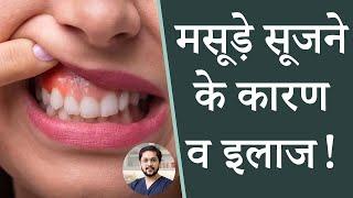 मसूड़े सुजने के कारण व इलाज  Dr Ankit Khasgiwala  Seraphic Dental  Indore