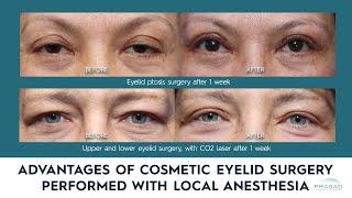 Advantages of Eyelid SurgeryBlepharoplasty Done Under Local Anesthesia