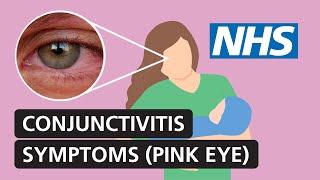 Conjunctivitis symptoms and treatment for red itchy watery eyes  NHS