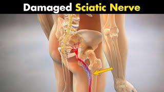 What Happens In Sciatica? - Symptoms Causes And Treatment UrduHindi