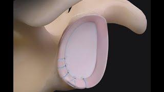 Posterior Labral Tear Repair With Tensionable Knotless 1.8 FiberTak® Soft Anchors