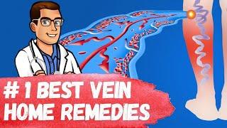 #1 Best Varicose Vein Home Remedies Spider Veins in Legs Treatment
