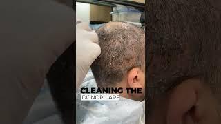 Head Wash After Hair Transplant  1st Head Wash  Scabs Removal