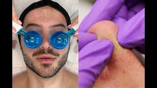 Male Detox Pore Cleansing Facial {Combo Skin}   Jadeywadey180