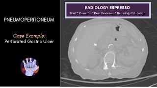 PNEUMOPERITONEUM Case Example – Pneumoperitoneum on CT Perforated Gastric Ulcer