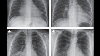 Legionella pneumphila جامعة الباحة  د. محمد بن عبدالله آل قمبر  محاضرة حول الليجونلا