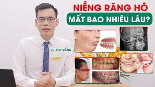 NIỀNG RĂNG HÔ LÀ GÌ  Niềng răng hô mất bao nhiêu lâu?