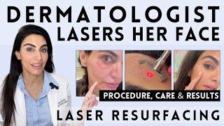 What it’s Like to Have Laser Resurfacing Procedure Care & Results  Dermatologist Tests