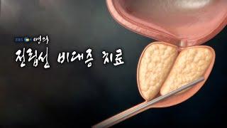 명의 의학백과 전립선 비대증 치료