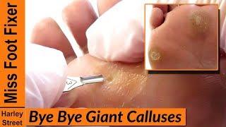 SATISFYING THICKEST AND GIANT CALLUSES REMOVAL