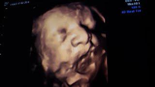 Dad Recognizes Babys Face In Ultrasound Learns Mom Lied