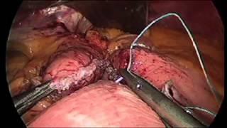 Gastric Bypass Surgery Demonstration Memorial Weight-Loss Surgery Program