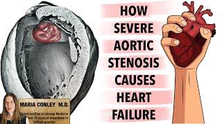 How Severe Aortic Stenosis Causes Heart Failure