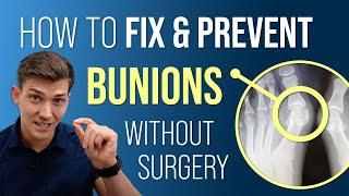 How to Fix & Prevent Bunions Without Surgery