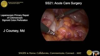 Laparoscopic primary repair of colonoscopic sigmoid colon perforation
